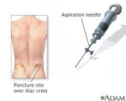 This is called a bone marrow test. Bone Marrow Biopsy Information Mount Sinai New York