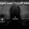 The ultrasound can help to show whether a cyst has any solid areas as it is more likely to be cancer. Https Encrypted Tbn0 Gstatic Com Images Q Tbn And9gcs7s1f45hgr7vullszgzhelfimsjzsoglyqns9f0efp104yj3pr Usqp Cau