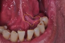 In the early stages, mouth cancer rarely causes any pain. Oral Cancer Emotional Dentistry Saving Lives City Dental