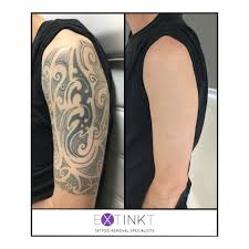While your tattoo may seem — and it was intended to be — permanent, the wide variety of photos shown in our before and after laser tattoo removal gallery show that the experts at medermis laser clinic are able to completely remove the pigment, giving you fresh and clean skin. Before After Tattoo Removal Results Laser Tattoo Removal Specialists
