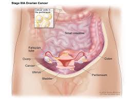 Symptoms of ovarian cancer can be quite vague so whether it's needing to go to the toilet more often, pain, bloating or something else, raise it with your. Ip Chemo For Ovarian Cancer Is Underused National Cancer Institute