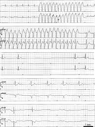 Serious Cardiac Arrhythmias After Stroke Stroke