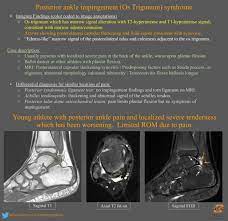 Posterior Ankle Impingement Os Trigonum Syndrome Grepmed