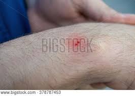 Next to it is a stethoscope and a protective medical disposable mask. Blood Poisoning Images Illustrations Vectors Free Bigstock