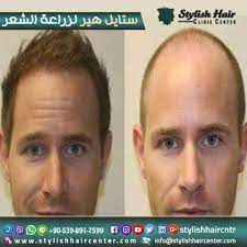 حدد شكل شعرك شعر اللحية والشارب شعر الحواجب ونلتزم بزرعه لك بأفضل تقنيات الميزوثيربي والبلازما الأمريكية و لاتحاتي الأسعار مع ستا stylish hair hair info