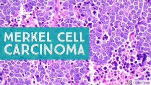 She had a history of multiple head and ne … Merkel Cell Carcinoma 101 Primary Cutaneous Neuroendocrine Carcinoma Youtube
