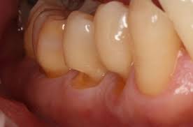 Abfraction Teeth Surgery Dental Health Care Dental
