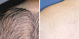 Face before & after photos. Laser Hair Removal For Men In Leeds And Bradford Good Skin Days
