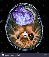 Gutartiger Hirntumor Farbige Computertomographie Ct Untersuchung Des Gehirns Eine 25 Jahrige Patientin Mit Einem Meningeom Lila Dies Ist Ein Gutartig Nicht Krebsartige Tumor Der Aus Der Hirnhaut Entsteht Die Membranen Die Das
