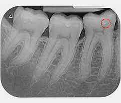 Wann eine wurzelbehandlung stattfindet, entscheiden zahnärzte anhand folgender kriterien gelingt dies nicht, ist eine operation nötig. Wurzelkanalbehandlung Endodontologie Endodontie Bonn Zahnarztpraxis Dr Zieger