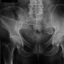 Plain Abdominal X Ray The V P Shunt Catheter Inside The Abdominal Cavity Download Scientific Diagram