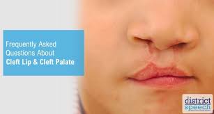 Image result for Cleft Lip