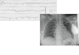 Röntgen's work on cathode rays led him, however, to the discovery of a new and different kind of rays. Cardiologisches Centrum Nurnberg Defibrillator S Icd