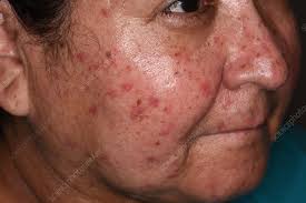 Image result for Connective Tissue Disorder