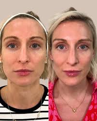 DAXXIFY ✨💉 Before & after treatment to crows feet, forehead & 11 lines