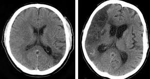 Possible signs of a stroke in cats include: Time Course Of Ischemic Stroke On Non Enhanced Ct Brain Stories