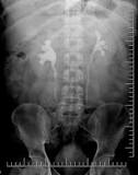 Image result for icd 10 code for right ureteral calculus