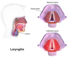Image result for Acute Laryngitis