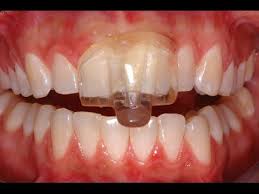 Aparelho Nti Para Bruxismo Youtube Tmj Grinding Teeth Teeth Clenching