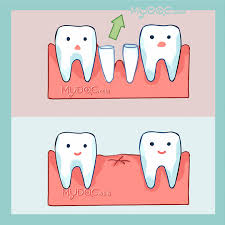 Gigi geraham atas kanan dengan kondisi periodontitis kronis,disini bisa ditandai dengan kondisi gigi nya yang sudah tidak. Operasi Penghapusan Akar Gigi Operasi Penghapusan Kista Terbaik Di Smile Avenue Dental Group