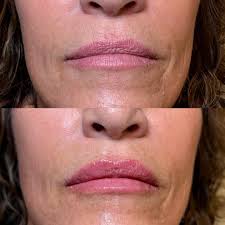 Mini hydration & plump with Kysse😘 👩‍⚕️Savannah Klein, MSN, NP-BC  💉Director of Aesthetics & Wellness ✨Arizona Health & Wellness Clinic  📍Gilbert, AZ 📞 480-931-3053 ⚠️ Consult with provider to determine the best