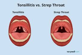 Image result for Strep throat infection roof of mouth