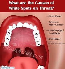 Usually these patches are irritating or painful, and sometimes the pain is. What Are The Causes Of White Spots On Throat