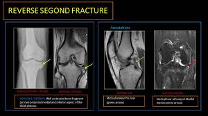 Image result for Segond Fracture