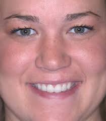 Dental Implants Las Vegas