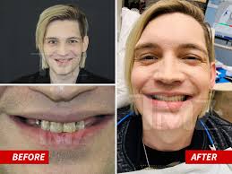 The Calling Singer Alex Band Gets New Teeth and It's Gnarly
