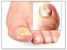 toenail fungus treatment st louis