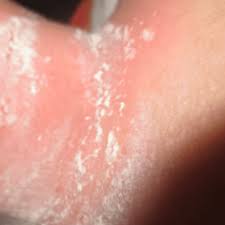 Intertrigo is inflammation of the skin. Intertrigo Pictures Rash Symptoms Causes Treatment Hubpages