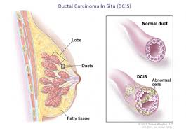 Dr sarah jarvis mbebreast cancer is one of the most common cancers. Breast Cancer Types Virginia Oncology Associates
