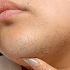 Image result for Hypertrichosis