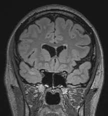 Connatal Cyst Mri Nuclear Medicine Cns Mri