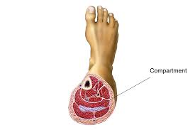 Image result for Compartment Syndrome