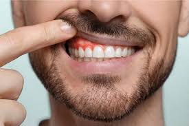 Image result for Gingivitis