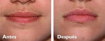 A diferencia del alejandrita, utiliza cabezales cuadrados, normalmente de menores en su día me hice la fotodepilación en la cara. Venta Laser Bigote Precio En Stock