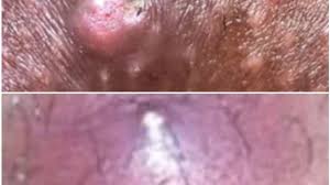 L'épilation des poils pubiens permet une hygiène et un confort de la zone intime, surtout pendant les règles. Poil Incarnes Pubis Bouton Youtube