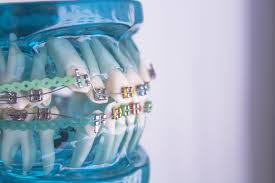 9.7 does it hurt getting braces off? How Do Your Teeth Move Blue Ridge Orthodontics