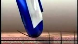 Wizzit Tweeze Electric Tweezers Hair Removal Epilator Youtube