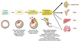 Although screenings for prostate cancer are one tool for early detecti. Cancers Special Issue Prostate Cancer Past Present And Future