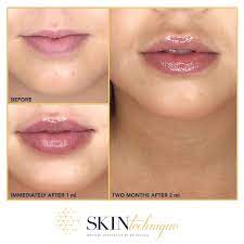 We got this client’s lips looking fuller than ever, with a definable contour lip line using the juvederm volbella injectable. Skin Technique On Twitter It S A Perfectly Acceptable Personal Choice To Have Kylie Jenner Lip Goals Dr Pavlou S Philosophy Is That It S Always Best To Approach More Dramatic Lip Goals Slowly And