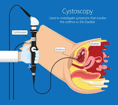 Image result for Prostatitis General Measures