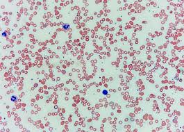 Image result for Peripheral Smear