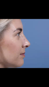 Rhinoplasty Before & After — An over-projected nasal tip is one of the most  common reasons patients seek a rhinoplasty surgery. With the proper  techniques, balance and harmony can be achieved to ...