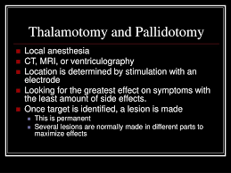 Image result for Pallidotomy