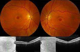 Online Ophthalmic Atlas Eye Health Optometry Eyes