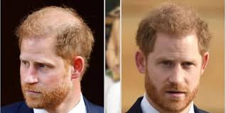Did Prince Harry Really Get a Hair ...