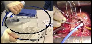 Pacemaker for iphone, ipad and apple watch. Leadless Pacemaker Implantation Under Direct Visualization During Valve Surgery The Journal Of Thoracic And Cardiovascular Surgery